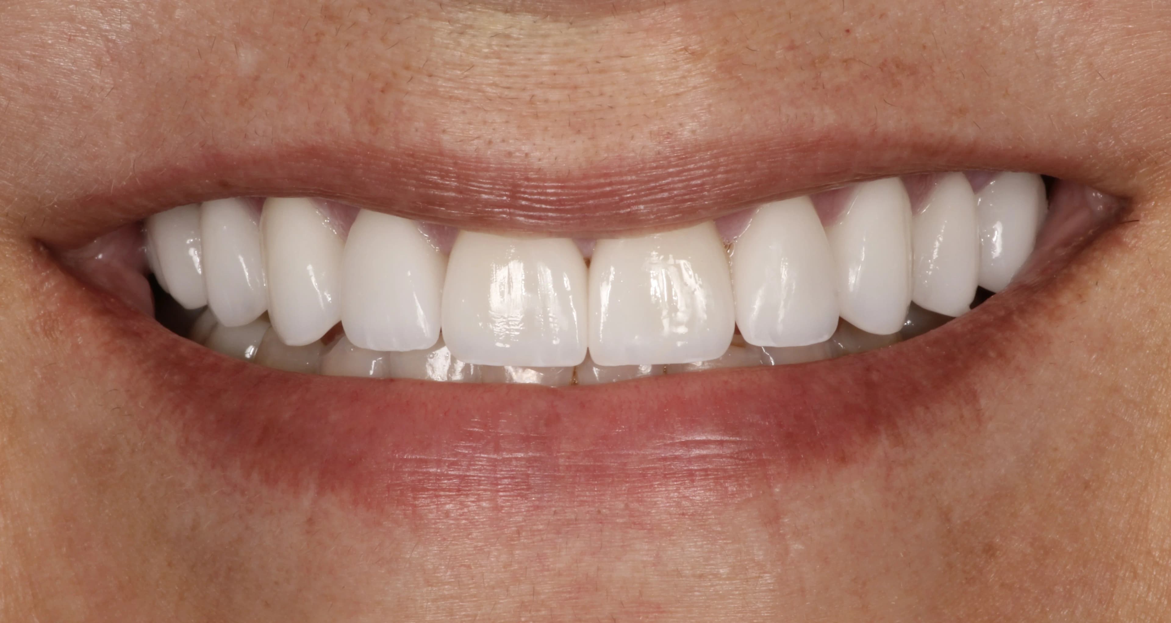Smile transformation, after treatment