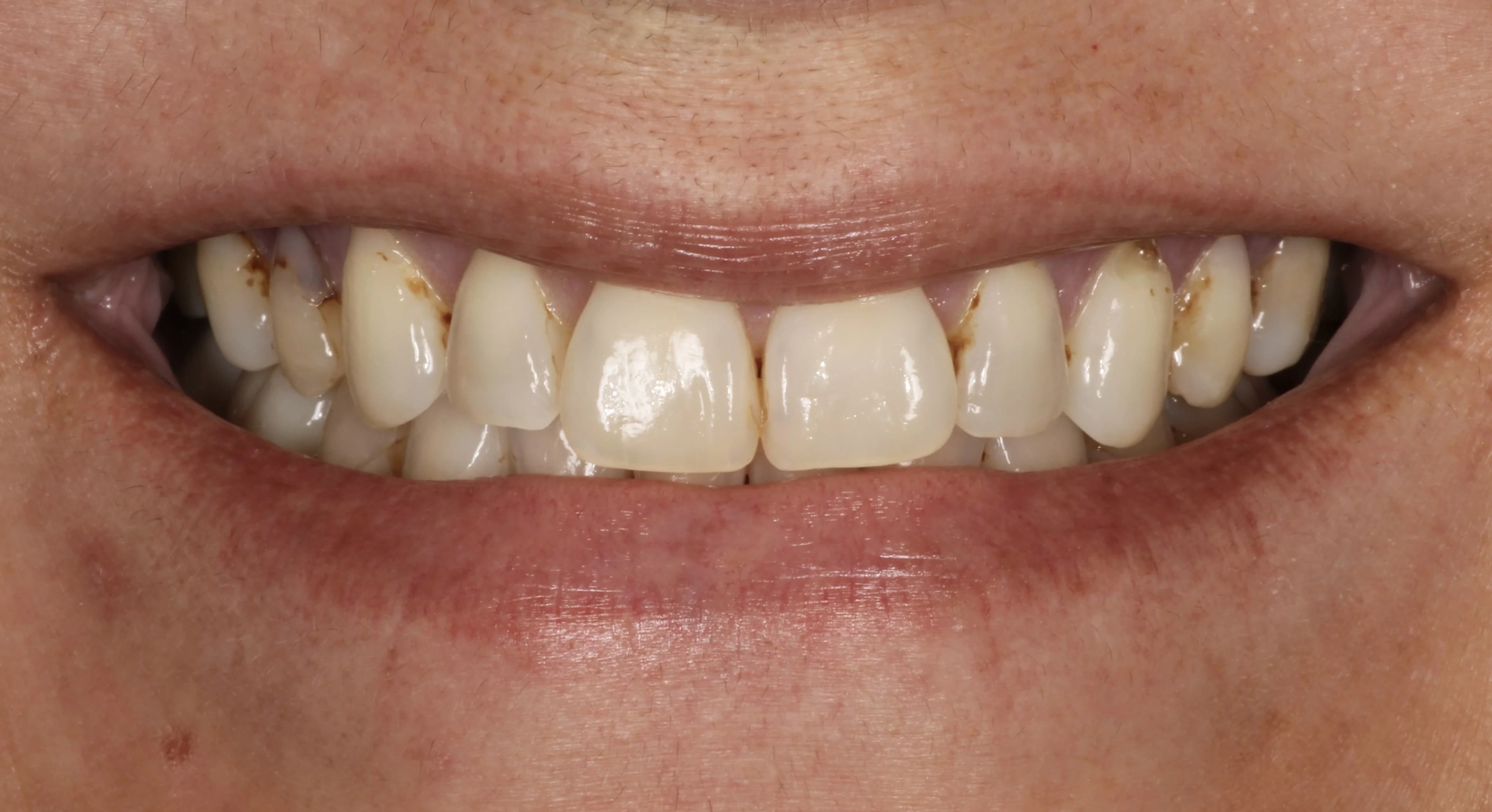 Smile transformation, before treatment
