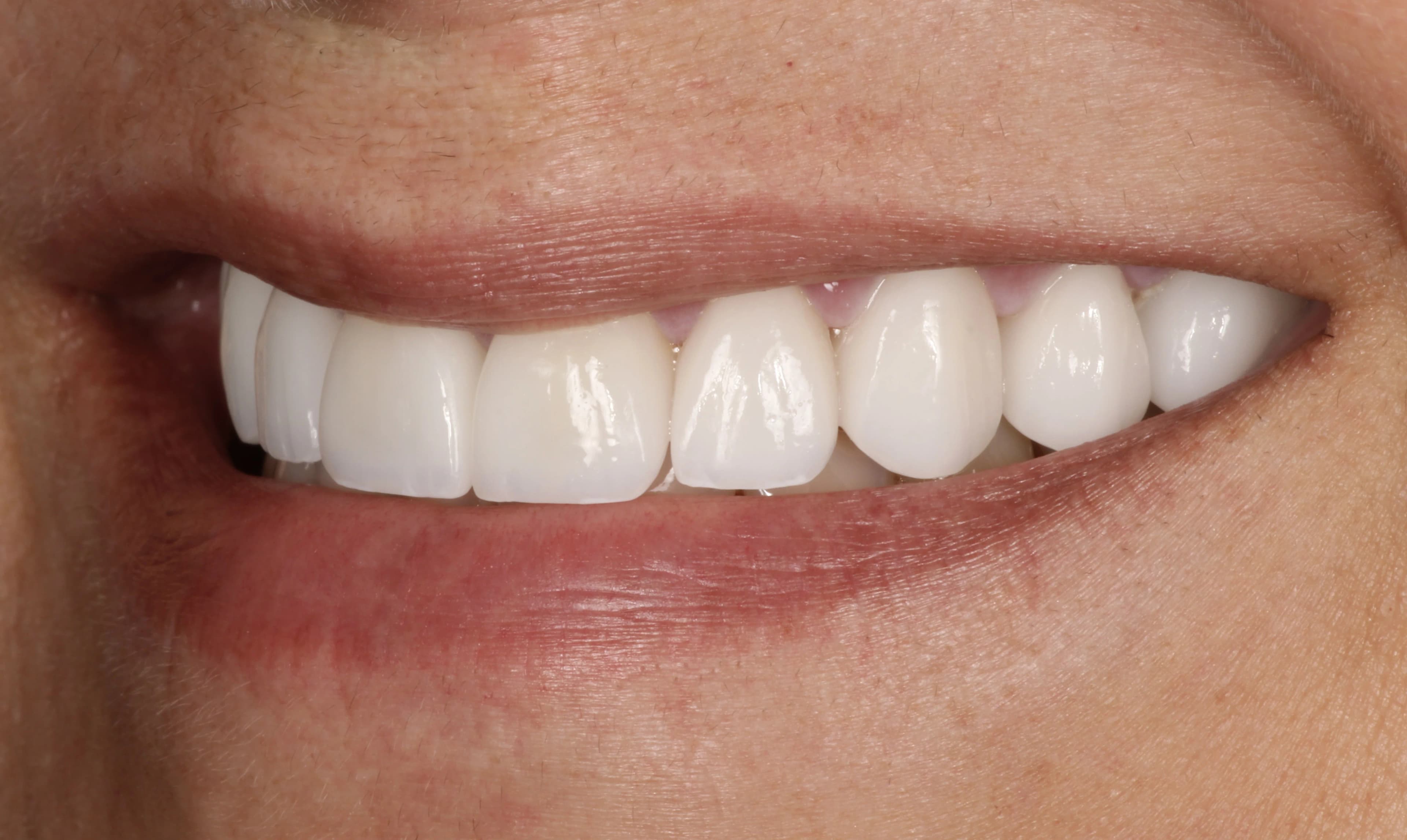 Smile transformation 2, after treatment