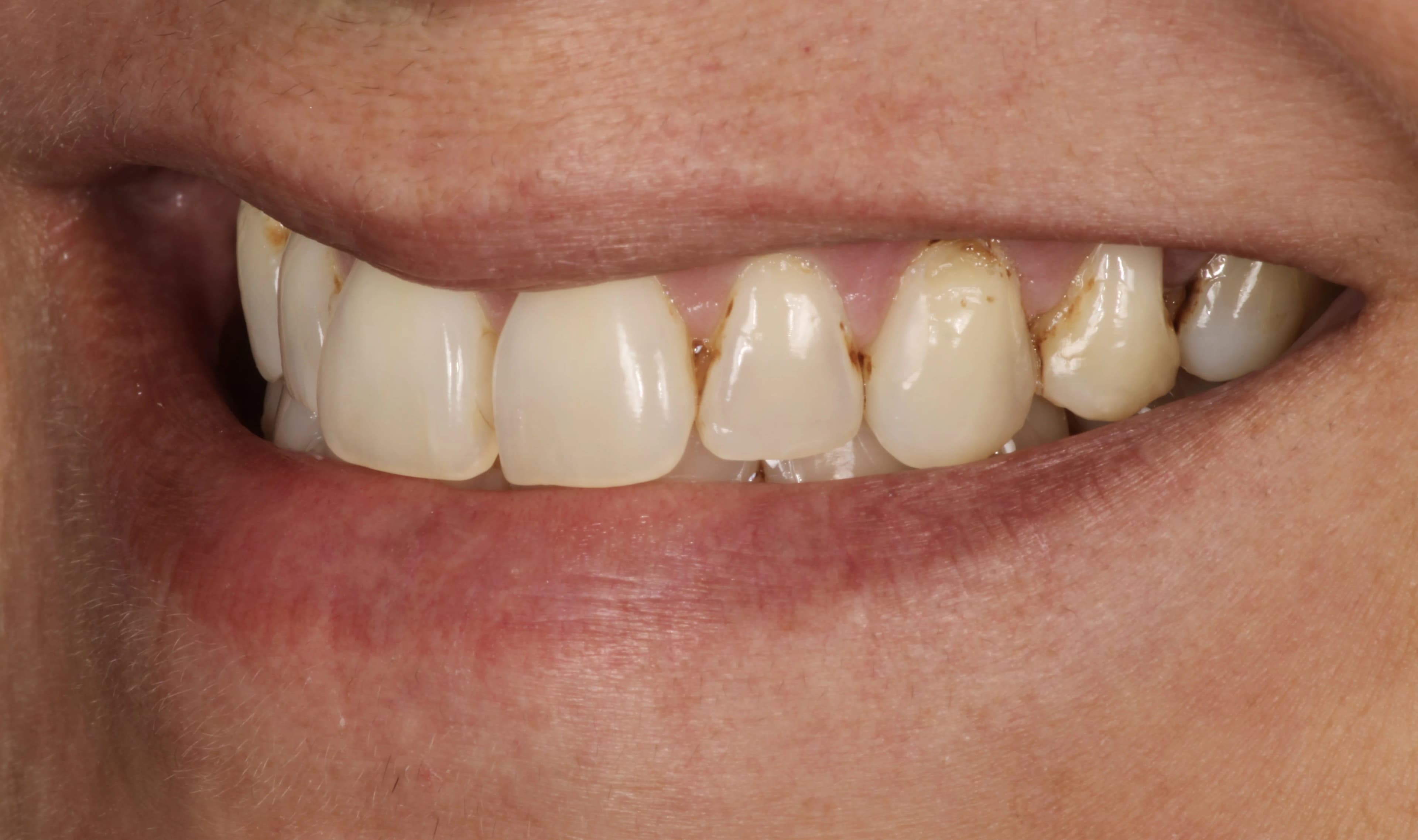 Smile transformation 2, before treatment