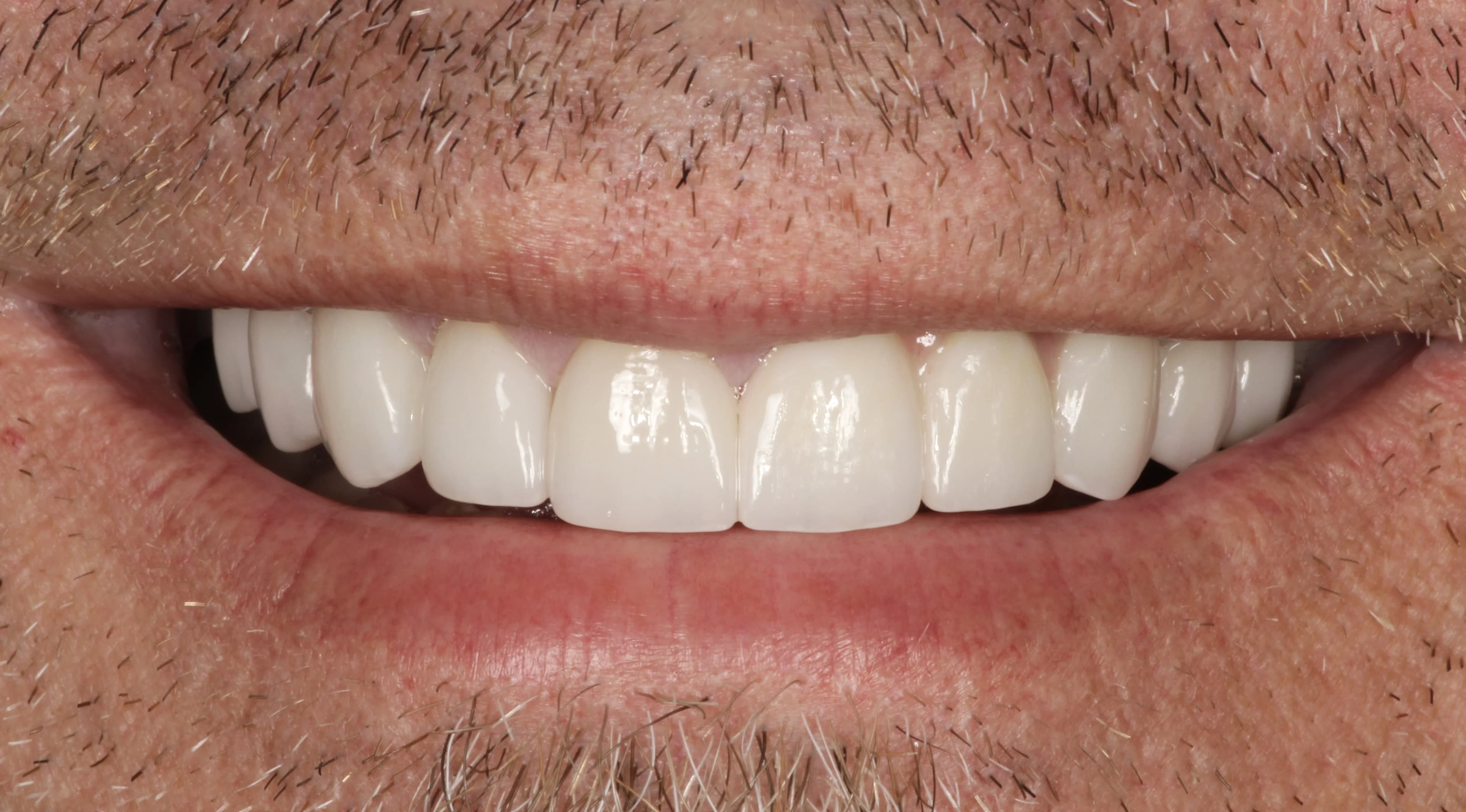 Smile transformation 3, after treatment