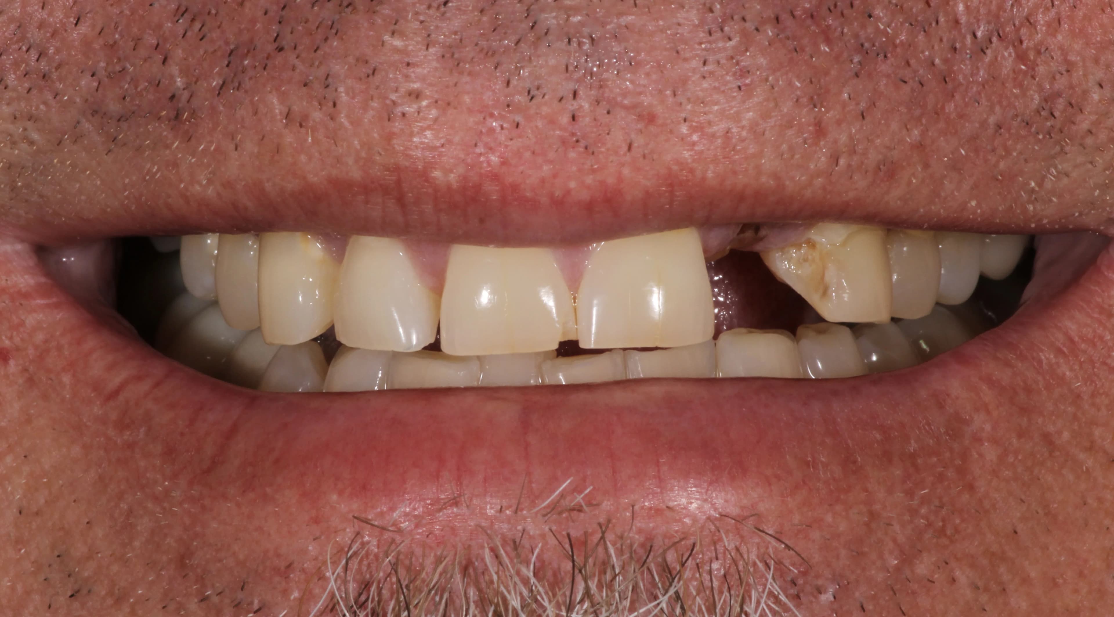 Smile transformation 3, before treatment
