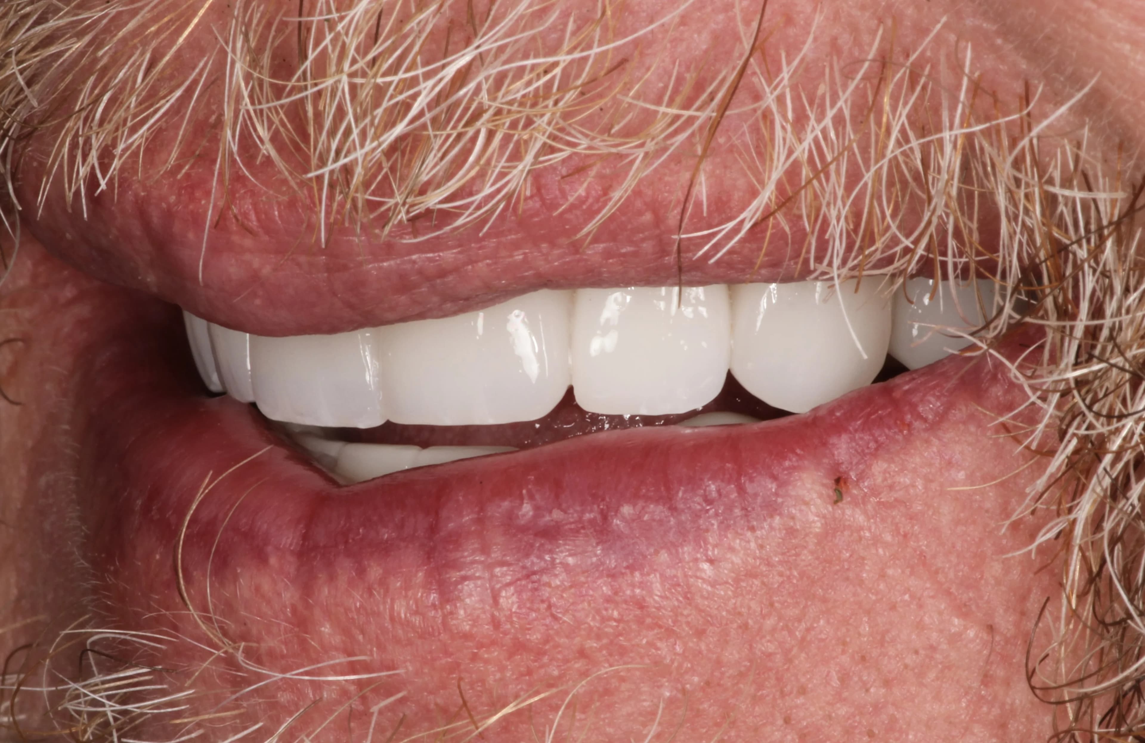 Smile transformation 4, after treatment
