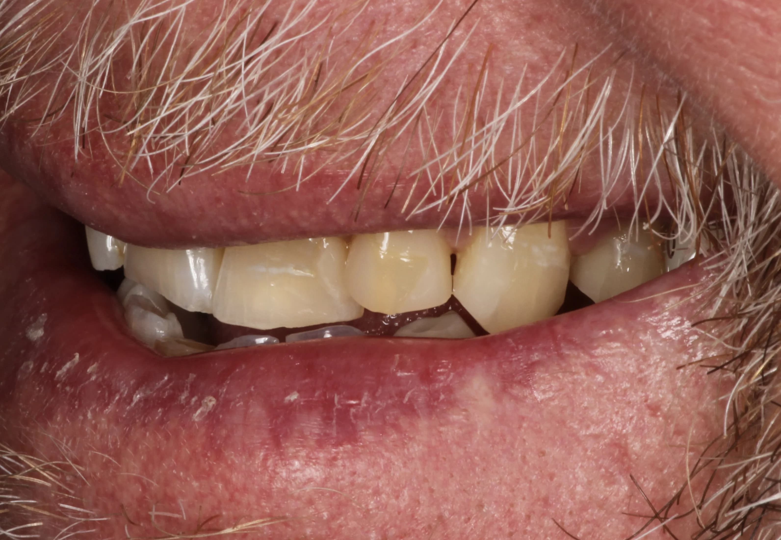 Smile transformation 4, before treatment