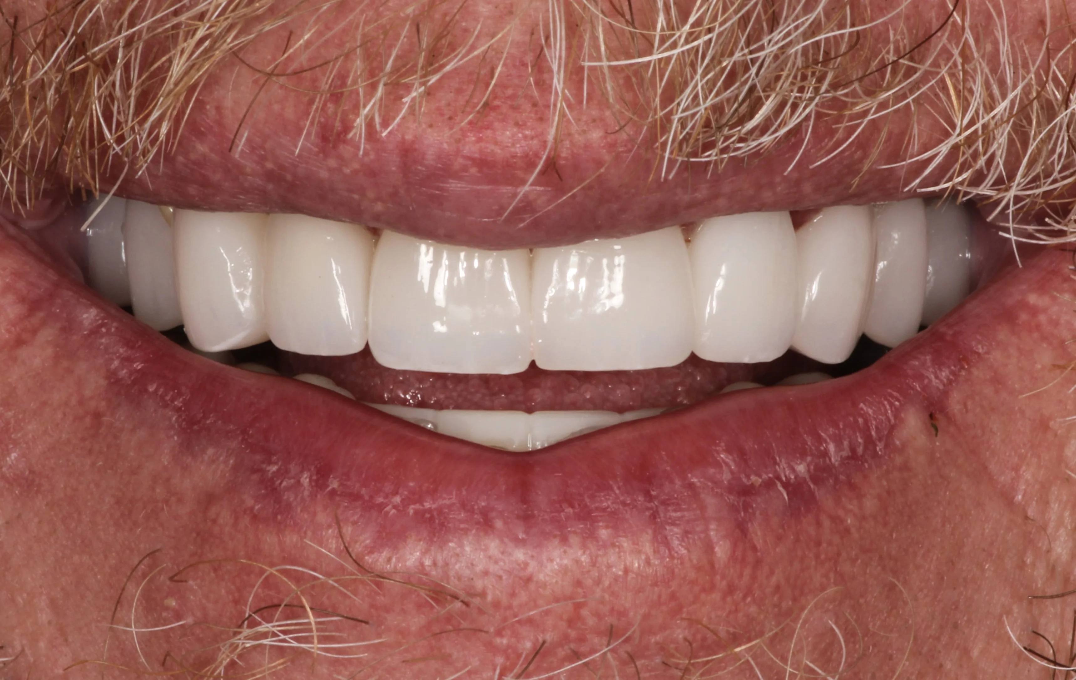 Smile transformation 5, after treatment