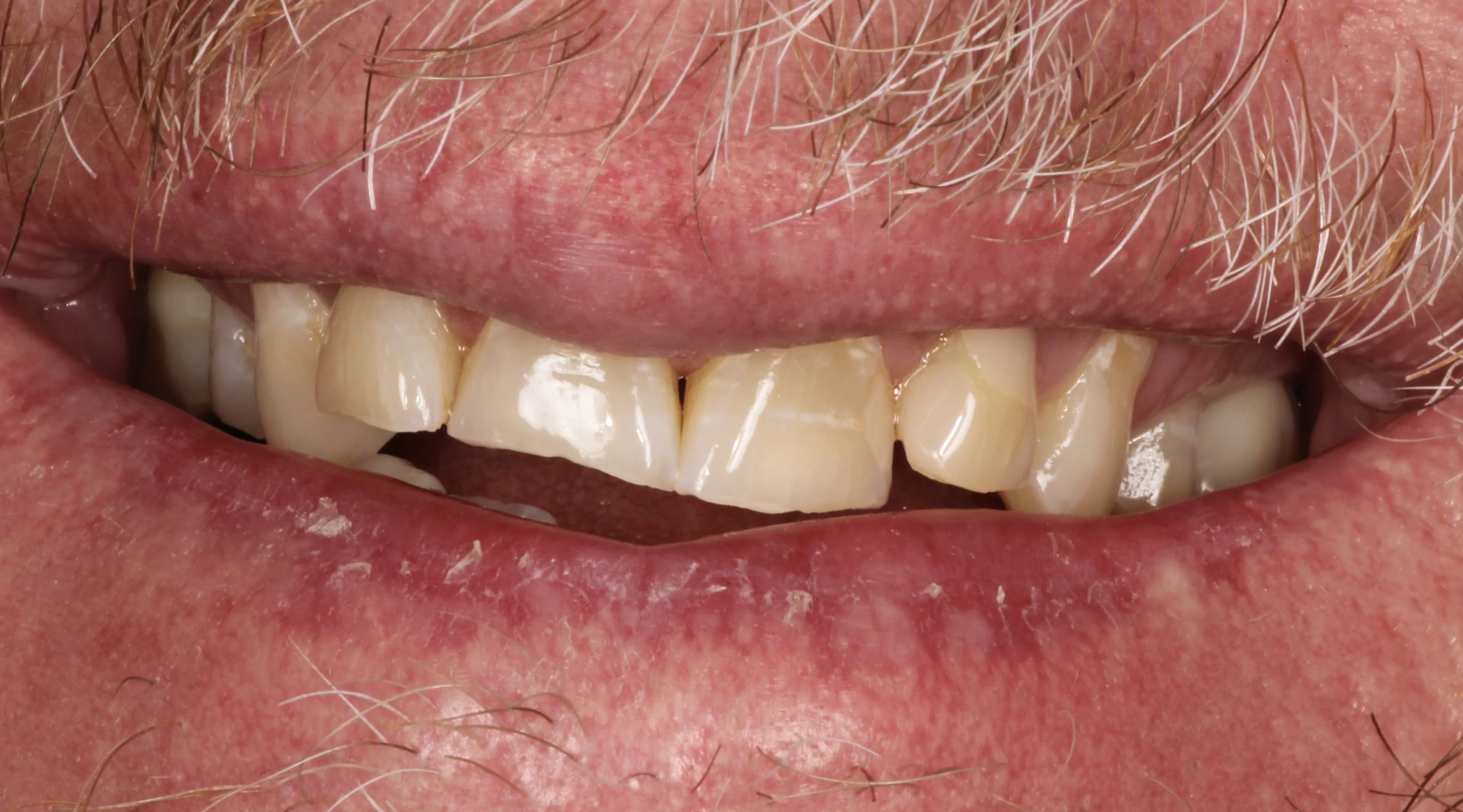 Smile transformation 5, before treatment