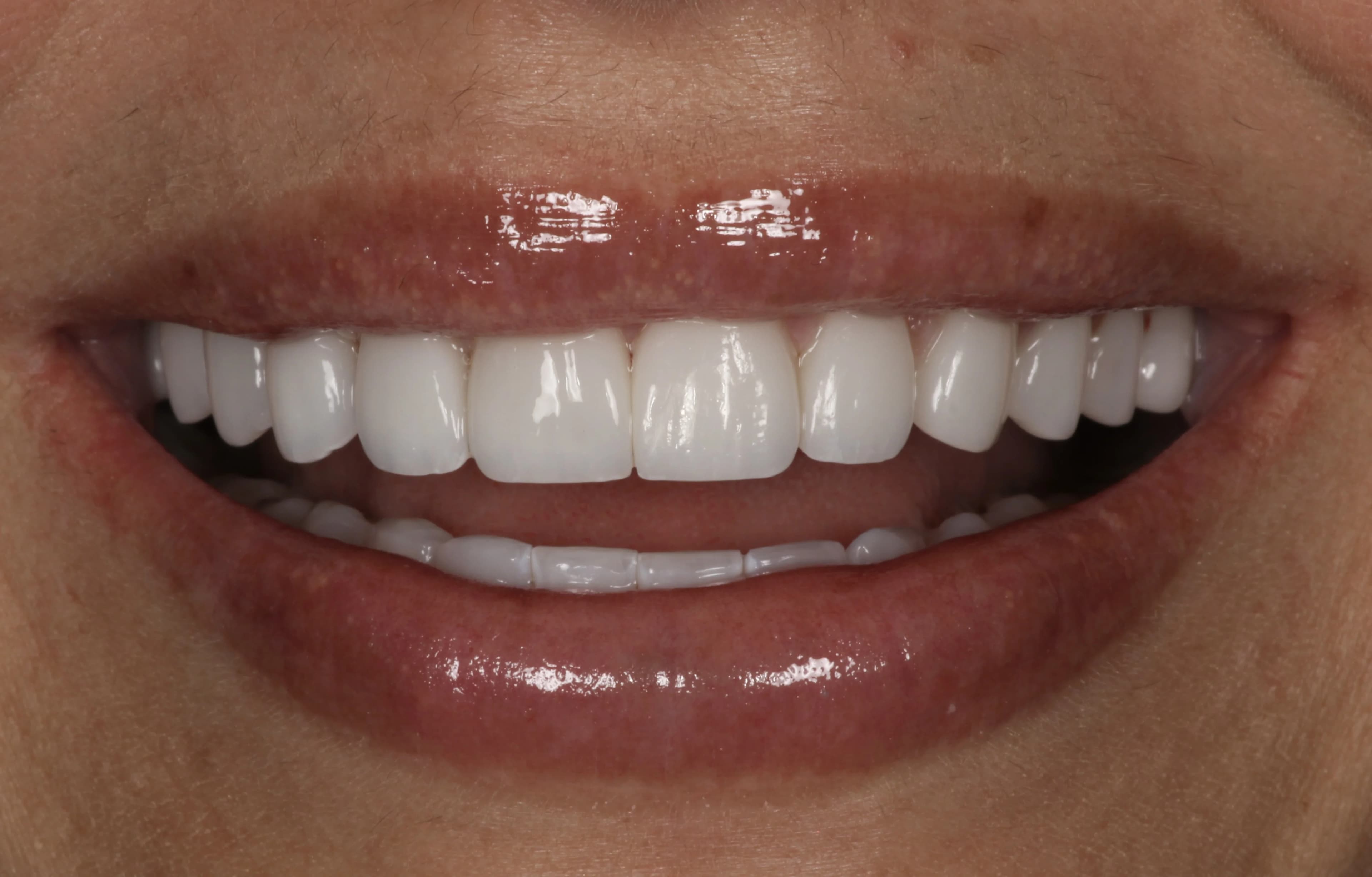 Smile transformation 6, after treatment