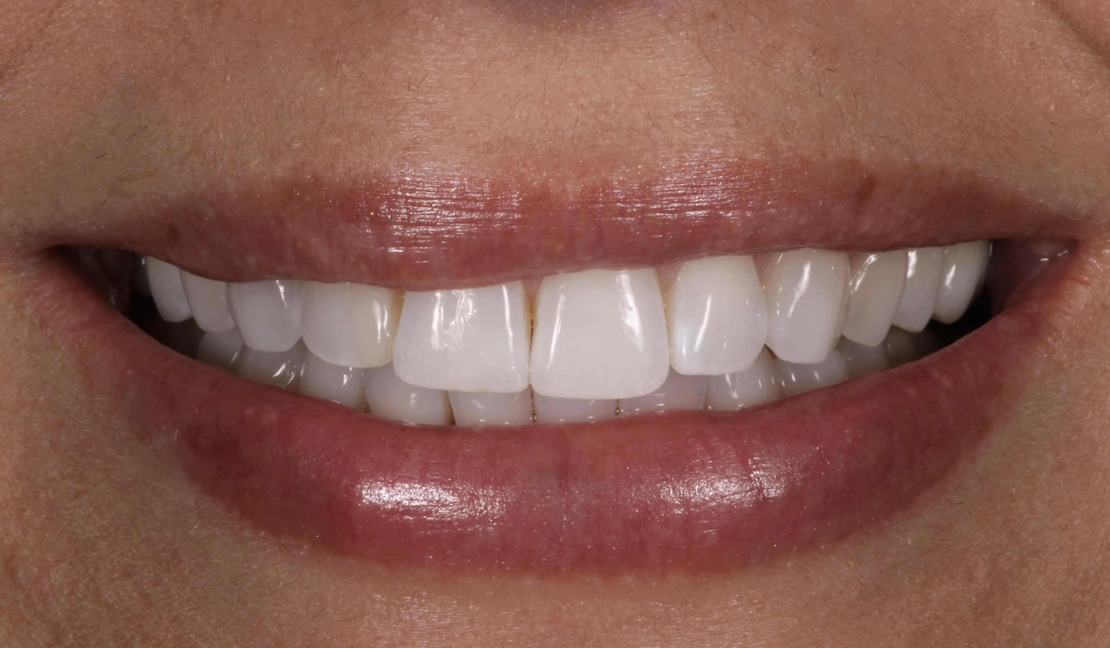 Smile transformation 6, before treatment