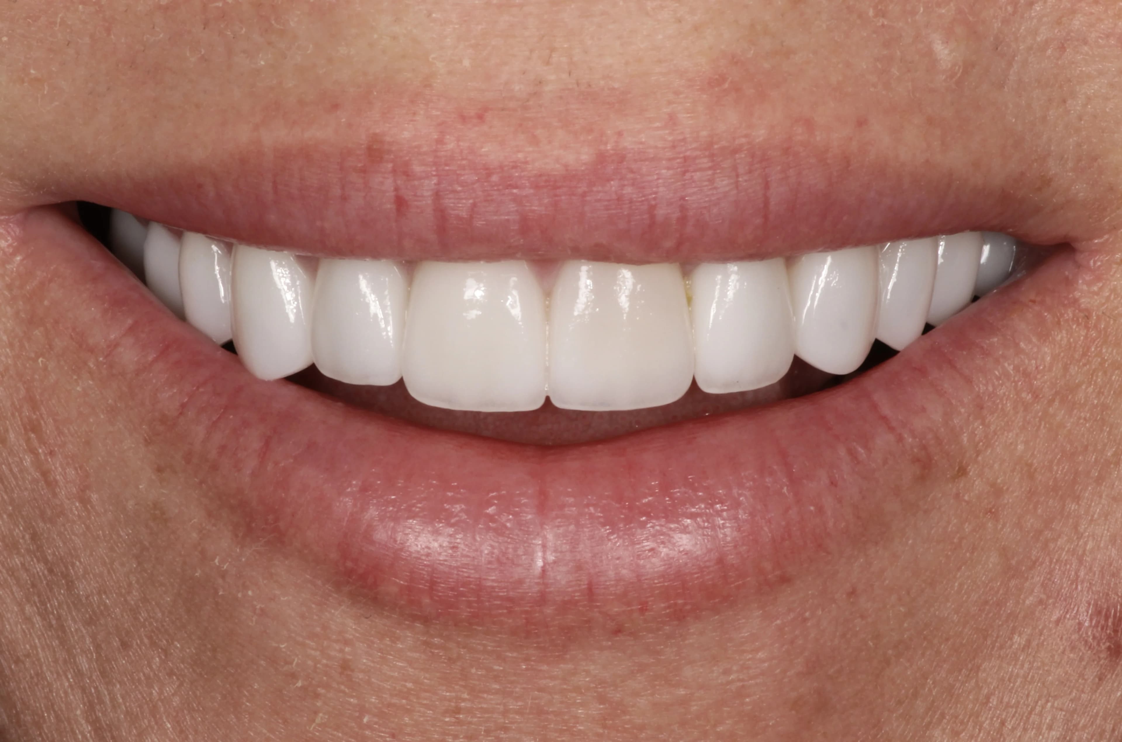 Smile transformation 7, after treatment