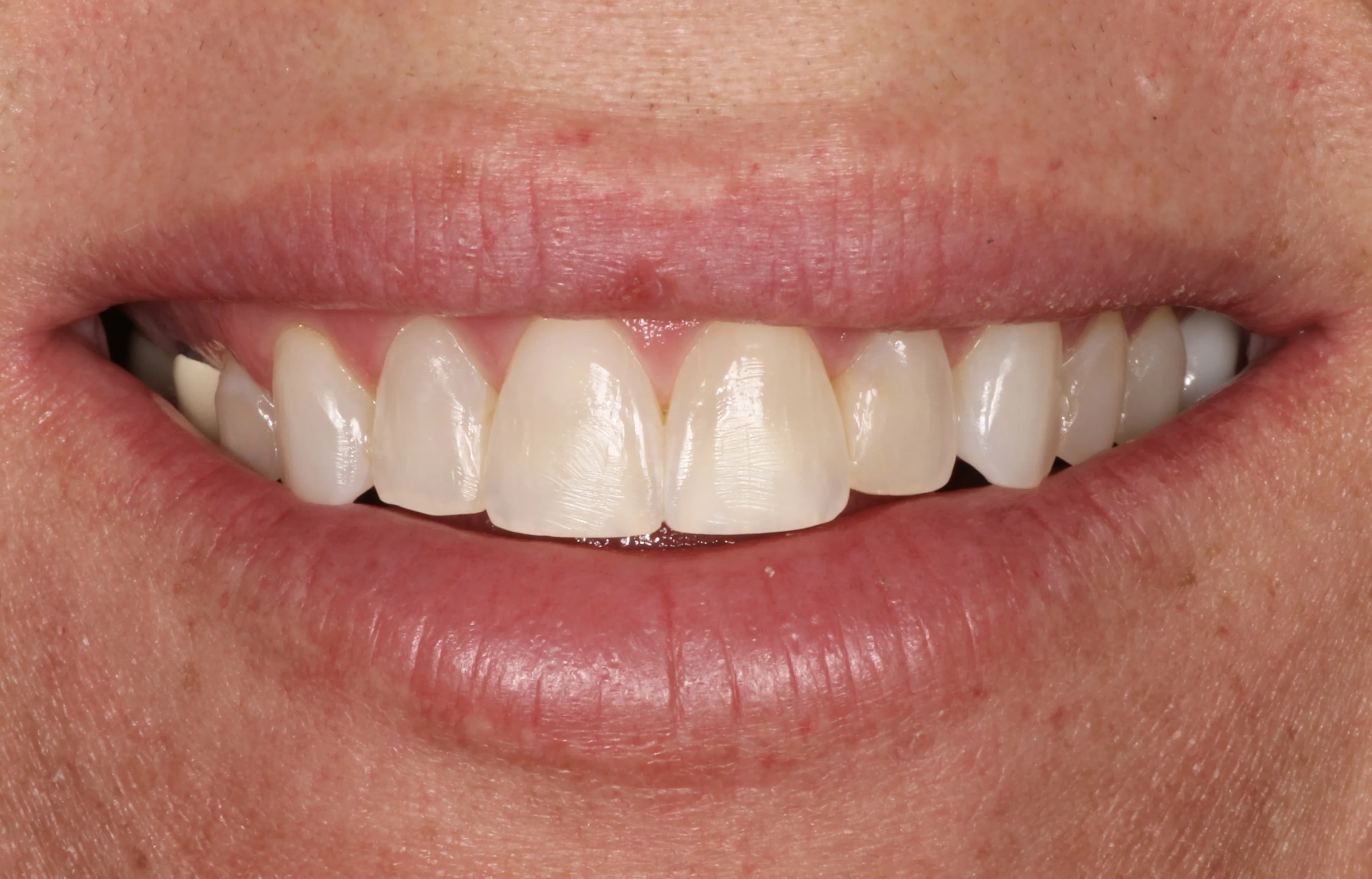 Smile transformation 7, before treatment