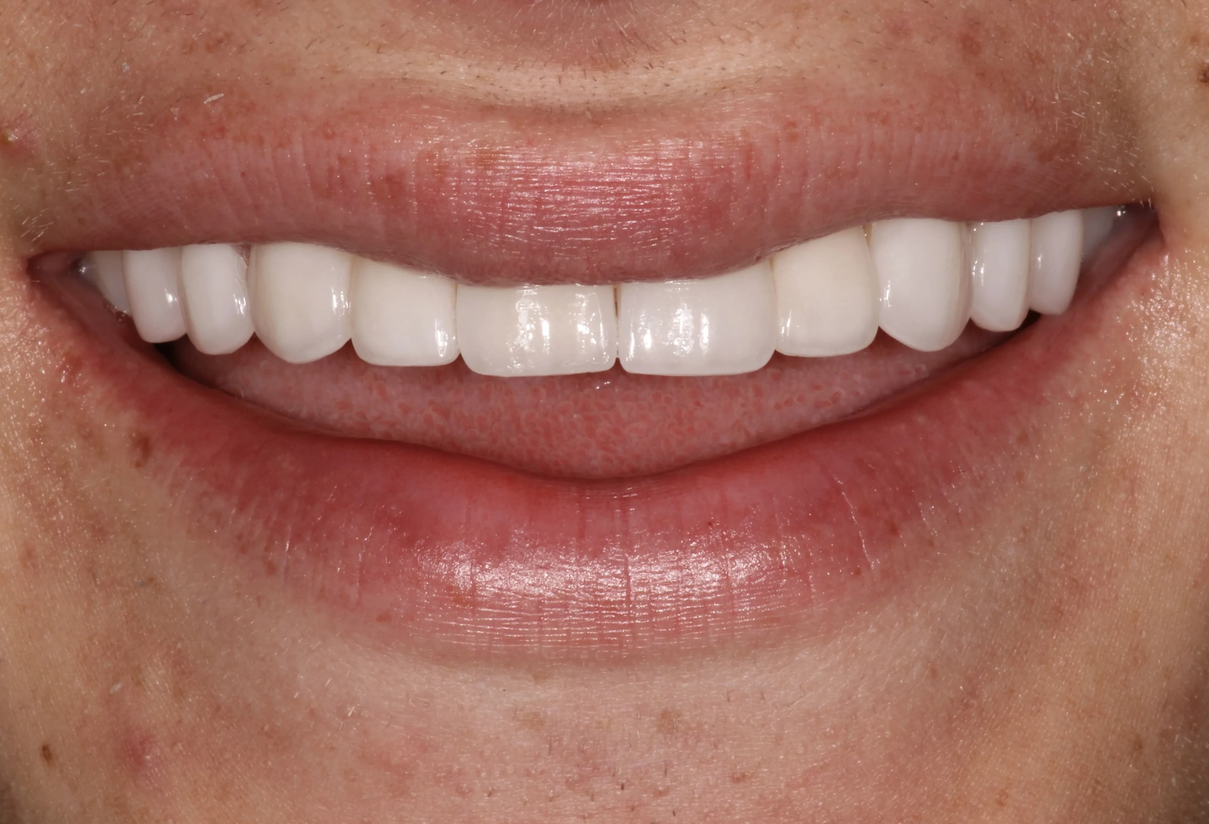 Smile transformation 8, after treatment