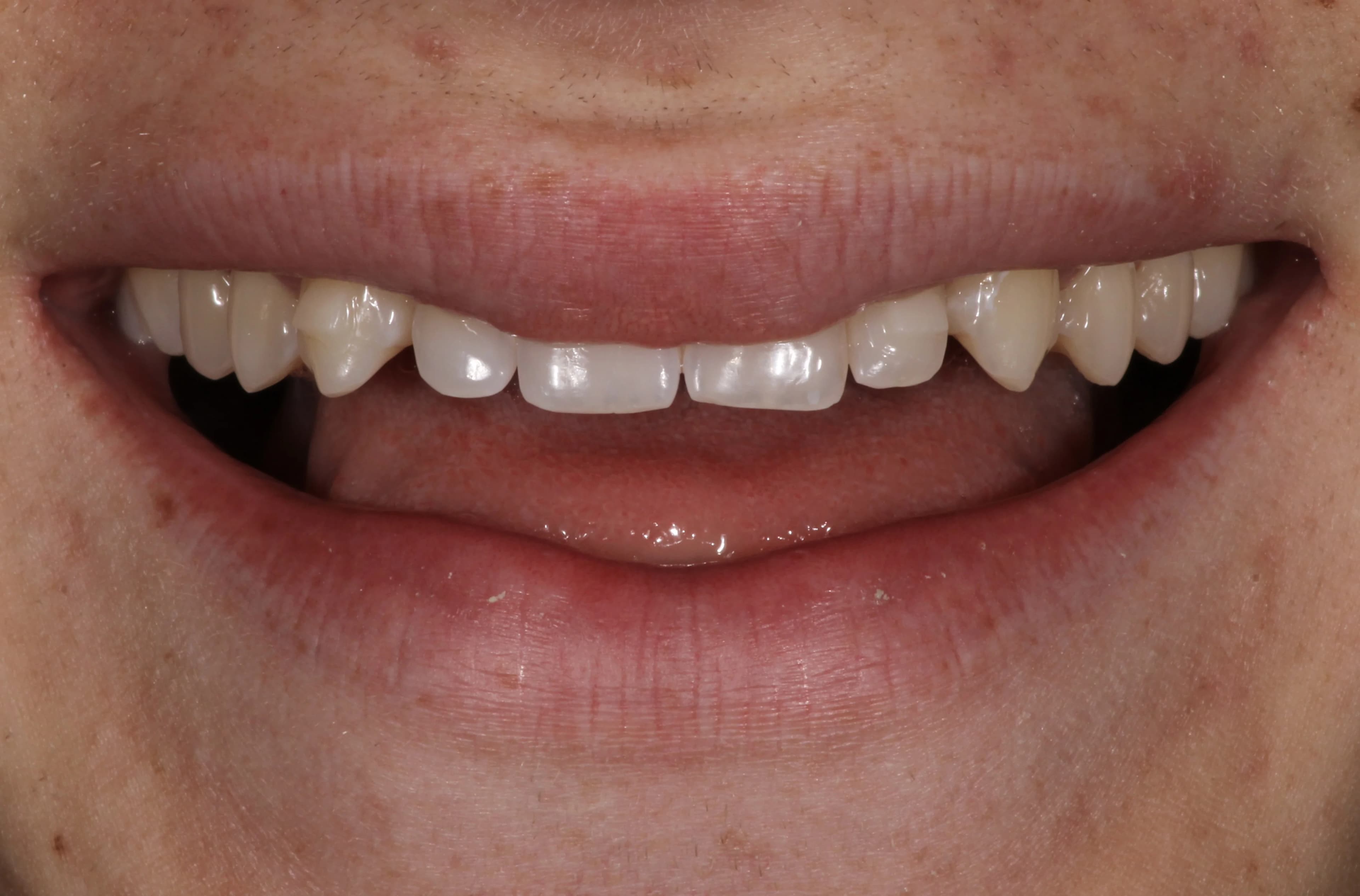 Smile transformation 8, before treatment