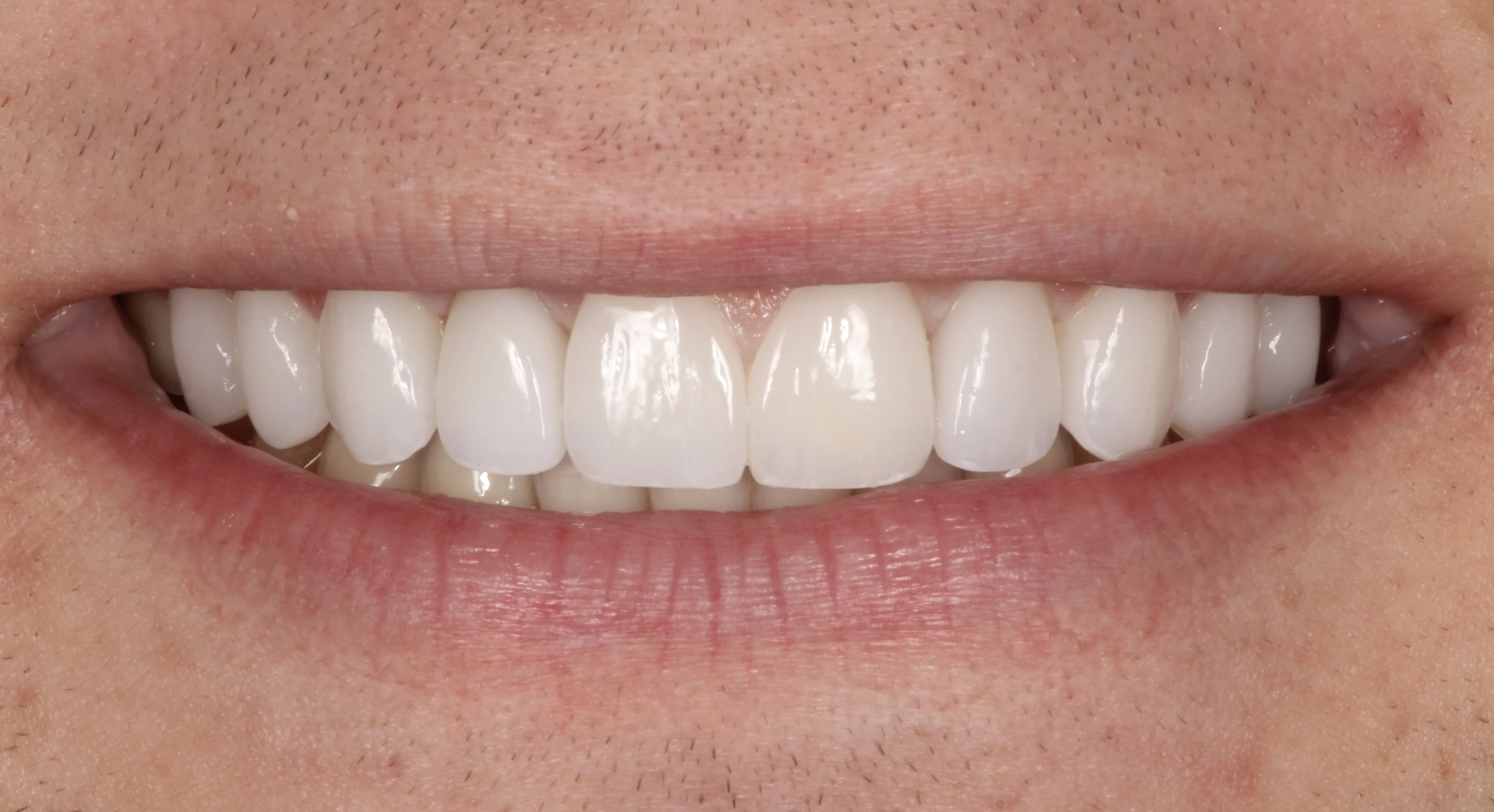 Smile transformation 9, after treatment
