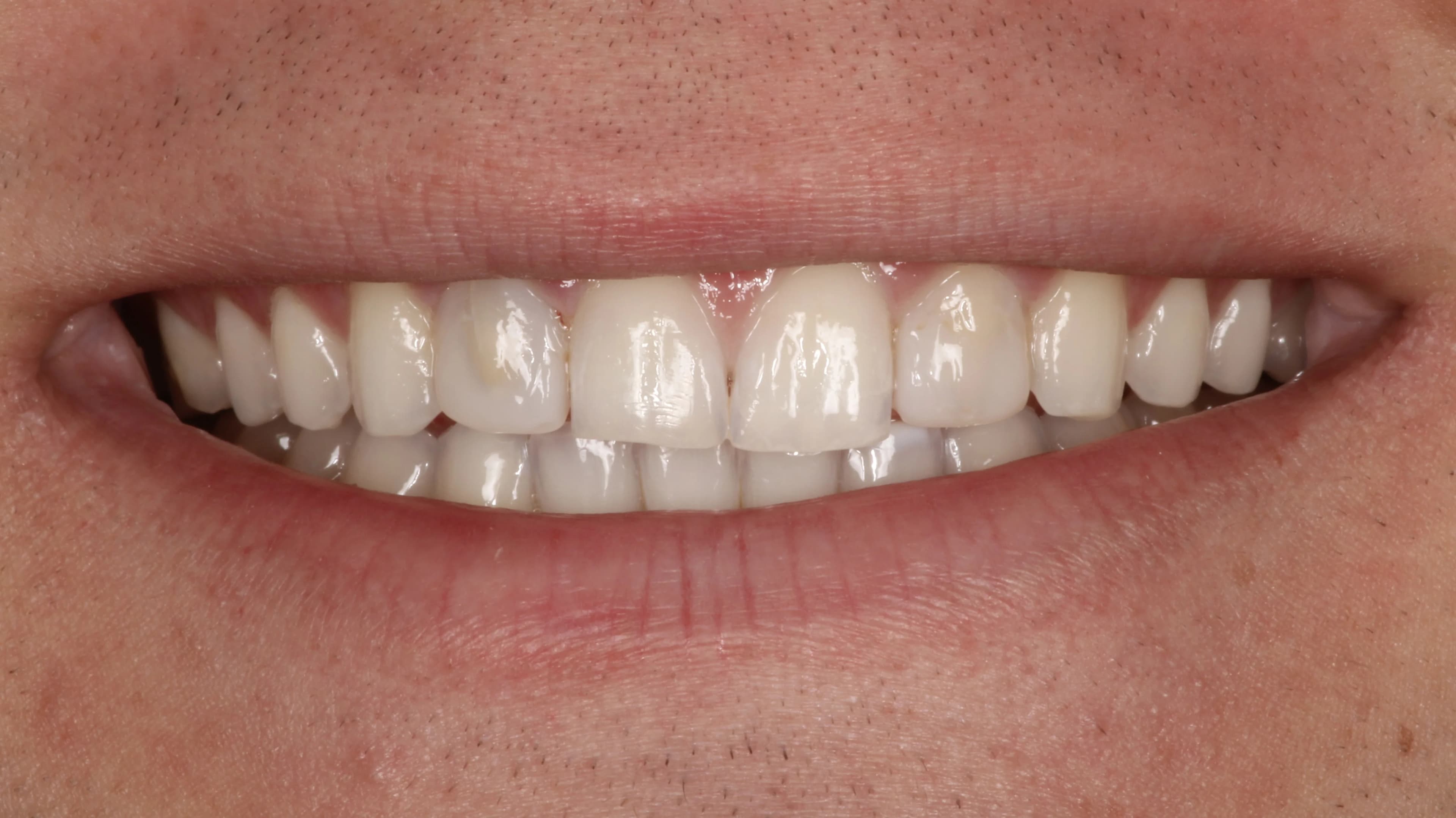 Smile transformation 9, before treatment